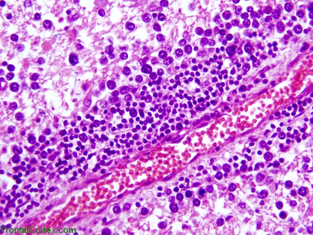 Primary CNS lymphoma, H&E stain x 400